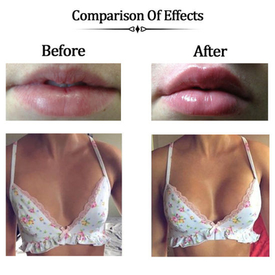 Cross Linked Hyaluronic Acid Filler Crosslinked Gel - Sodium Hyaluronate đã được chứng minh lâm sàng