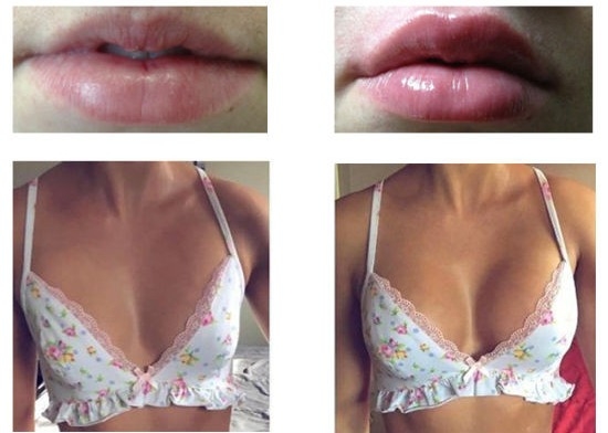 Tiêm làm nở ngực Cấy axit hyaluronic vào môi Tiêm chất làm đầy da