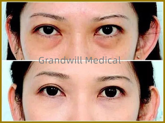 Chất làm đầy da mặt bằng axit hyaluronic để làm đầy vết rách cho vòng tròn mắt