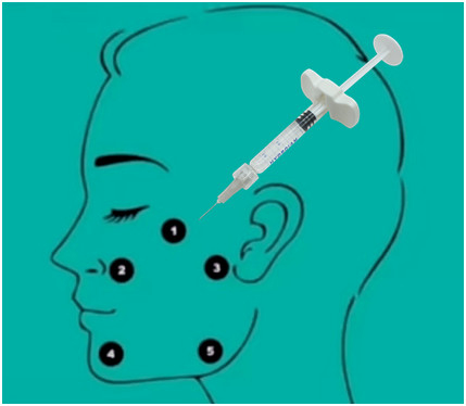 32mg H-HA L-HA Gel làm đầy axit hyaluronic không liên kết chéo với nhau