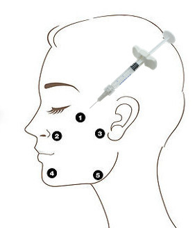 OEM Profhilo H + L 32mg Chất làm đầy axit hyaluronic không liên kết chéo 5 điểm Tiêm