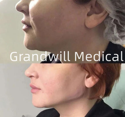 2ml H + L 32mg / Ml Axit hyaluronic tăng cường làn da để nâng cơ mặt chống lão hóa