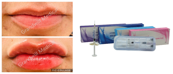 Chất làm đầy da Natri Hyaluronic Acid liên kết chéo cho nếp nhăn trên khuôn mặt đầy đặn