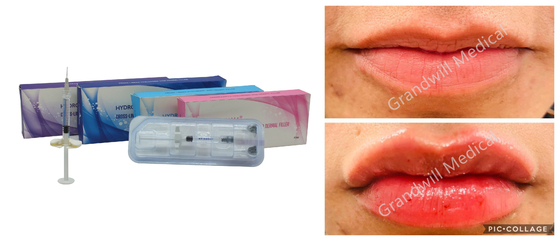 5ml Lip Filler Hyaluronic Acid Injection Gel Filler Bottle Syringe Package Điều trị nếp nhăn mặt