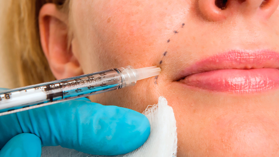 Collagen kích thích PCL Dermal Filler Gel axit hyaluronic với CMC chống nhăn