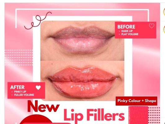 Chức năng môi Dermal Lip Fillers 1ml Đối với OEM Chất lấp đầy môi tự nhiên