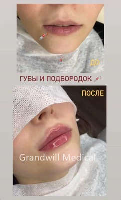 24mg/ml Axit hyaluronic tiêm để làm mịn nhăn