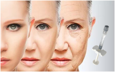 Chất làm đầy mặt bằng axit hyaluronic 24mg / Ml cho chứng lõm má Chân quạ