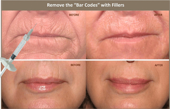 10ml Tiêm chất làm đầy da Hyaluronic Acid để điều chỉnh sự bất đối xứng trên khuôn mặt