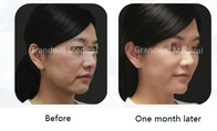 CMC PCL Dermal Filler Bộ kích thích Collagen để loại bỏ nếp nhăn trên khuôn mặt