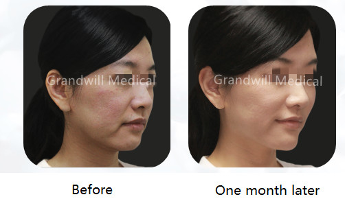 PCL Polycaprolactone Hyaluronic Acid Filler Chất làm đẹp y tế Tiêm kích thích Collagen