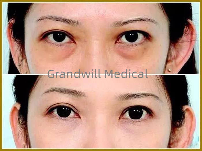Chất làm đầy da mặt bằng axit hyaluronic để làm đầy vết rách cho vòng tròn mắt