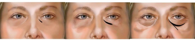 1ml 2ml dung dịch axit hyaluronic tiêm loại bỏ mắt điều trị quầng thâm