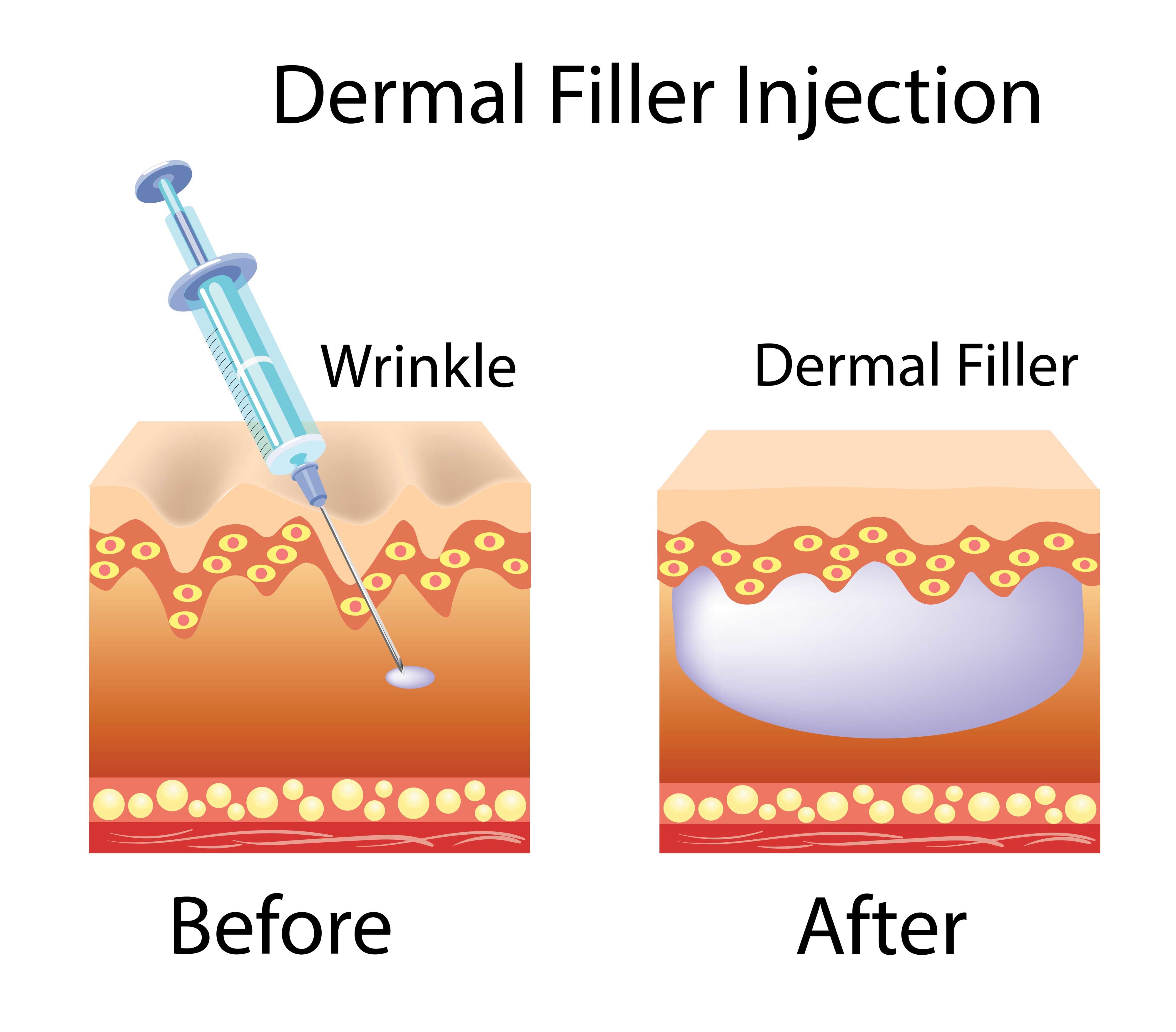 Hyaluronic Acid Filler Manufacturer Injectable Modified Sodium Hyaluronate Gel Đối với khuôn mặt và cơ thể