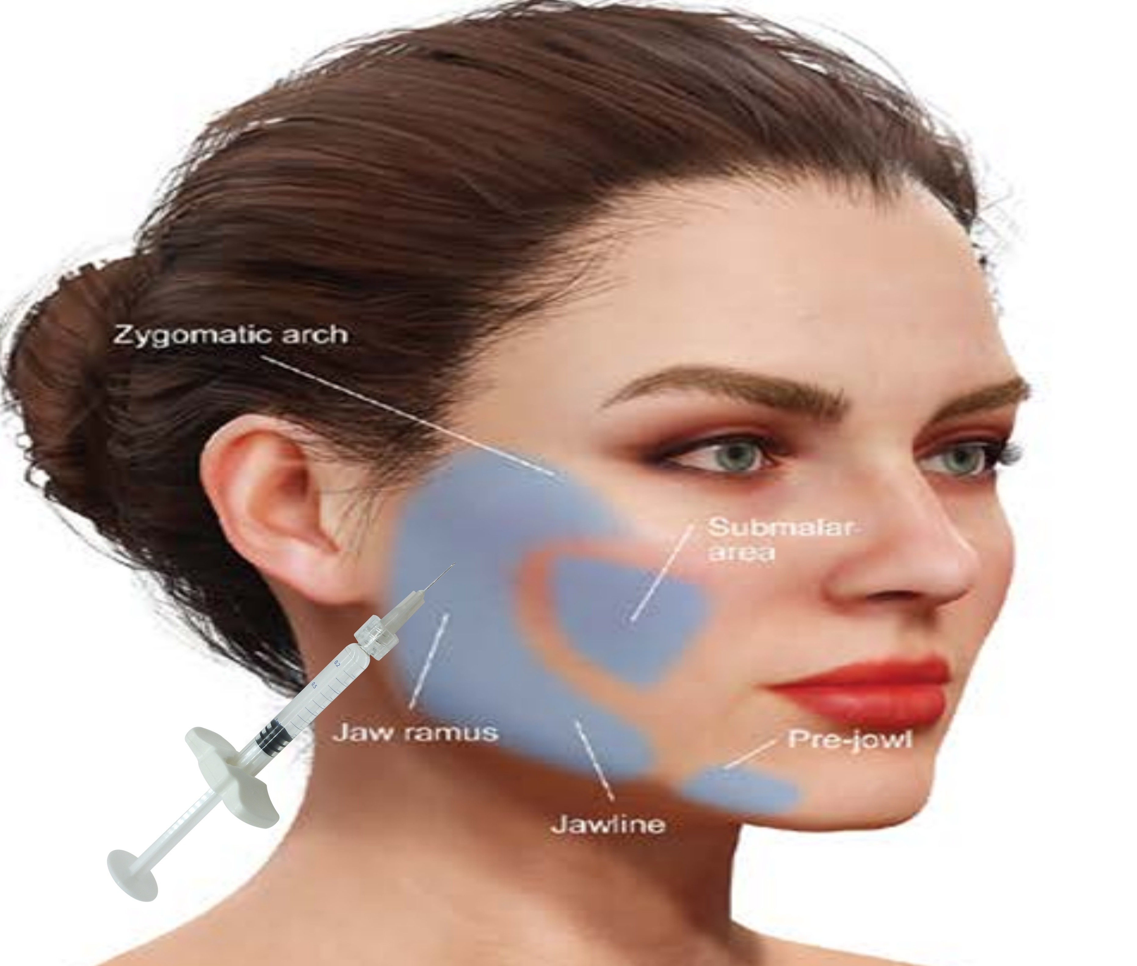 Hyaluronic Acid HA Calcium Hydroxyapatite Filler Nhận khuôn mặt trông tự nhiên với ống tiêm 1ml