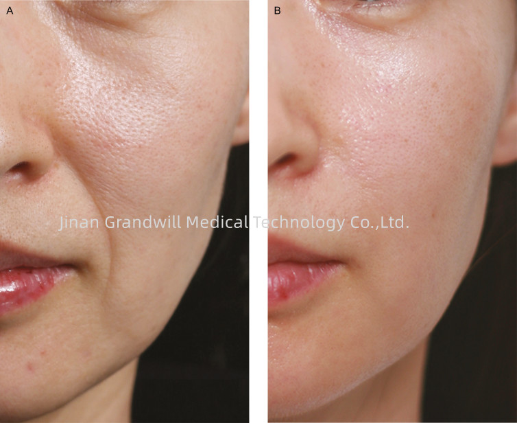 Miracle HL PCL Skin Booster Polycaprolactone Dầu nhựa nhựa nhựa nhựa nhựa nhựa nhựa nhựa nhựa nhựa nhựa nhựa nhựa nhựa nhựa nhựa nhựa nhựa nhựa nhựa nhựa nhựa nhựa nhựa nhựa nhựa nhựa nhựa nhựa nhựa nhựa nhựa nhựa nhựa nhựa nhựa nhựa nhựa nhựa nhựa nhựa nhựa nhựa nhựa nhựa nhựa nhựa nhựa nhựa nhựa nhựa nhựa nhựa nhựa nhựa nhựa nhựa nhựa nhựa nhựa nhựa nhựa nhựa nhựa nhựa nhựa nhựa nhựa nhựa nhựa nhựa nhựa nhựa nhựa nhựa nhựa nhựa nhựa nhựa nhựa nhựa nhựa nhựa nhựa nhựa nhựa nhựa nhựa nhựa nhựa n