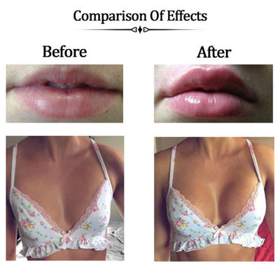 Kiểm tra lâm sàng liên kết chéo Natri Hyaluronate Gel Face Filler với các kỹ thuật an toàn nhất