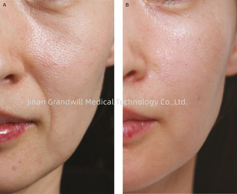 PCL liên kết chéo Hyaluronic Acid Chất làm đầy da Polycaprolactone