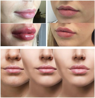 Đường nét mịn màng / Đôi môi căng mọng với chất làm đầy tiêm axit hyaluronic 1ml 2ml 5ml