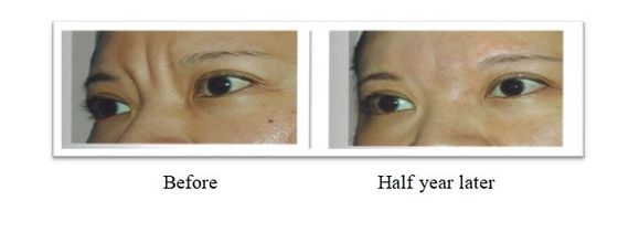 350mg 150mg PLLA Poly L Lactic Acid Dermal Filler Đối với điều trị nếp nhăn trên khuôn mặt