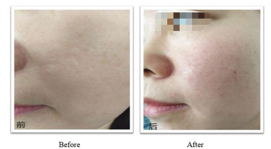 350mg 150mg PLLA Dermal Filler OEM Tùy chỉnh Tiêm Plla Để có kết quả lâu dài