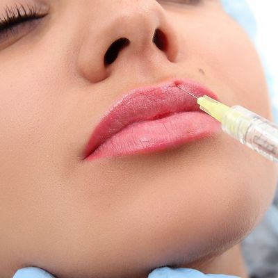 Chất làm đầy môi dạng gel 24mg / Ml Hyaluronic Acid tự nhiên