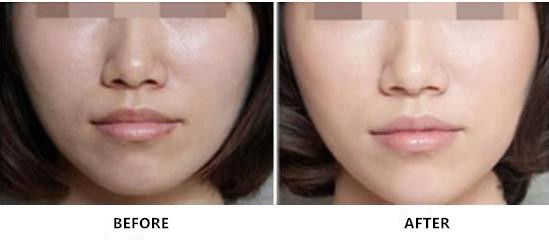 Tiêm trẻ hóa Sodium Hyaluronate không liên kết chéo để chăm sóc da