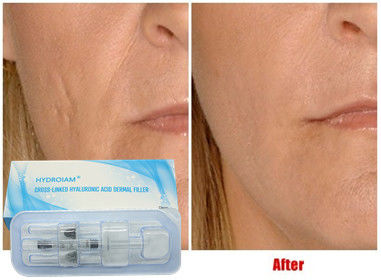 Chất làm đầy có thể tiêm axit hyaluronic 10ml cho môi tiêm má cằm