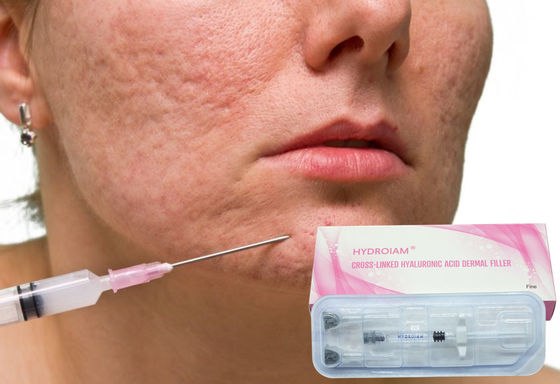 1ml Sodium Hyaluronate Gel Tiêm để loại bỏ các nếp nhăn trên khuôn mặt