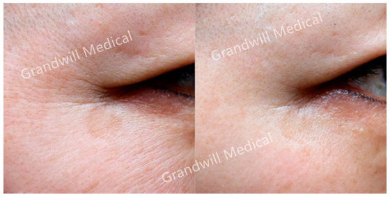 2ml Pcl Skin Booster Polycaprolactone Kích thích Tái tạo Collagen Da