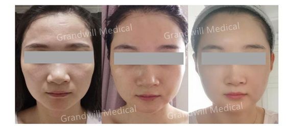 Nâng cơ mặt HA PCL Dermal Filler Miracle Touch Up Microneedling Injection