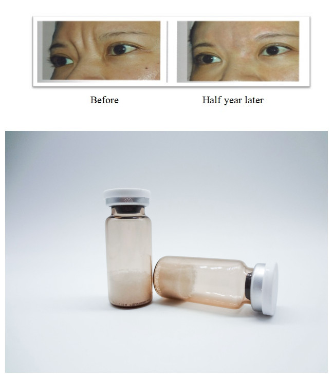 PLLA Poly-L-Lactic Acid Injectable Dermal Filler Loại bỏ nếp nhăn trên khuôn mặt Khuyến khích tái tạo collagen